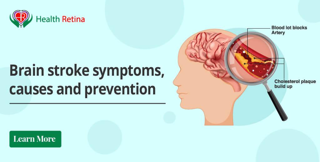 Brain stroke symptoms, causes and prevention