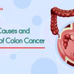 Colon Cancer Symptoms, Causes and Prevention The colon is the opening