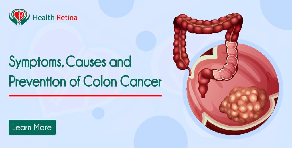 Colon Cancer Symptoms, Causes and Prevention The colon is the opening