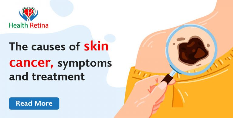 The causes of skin cancer, symptoms and treatment